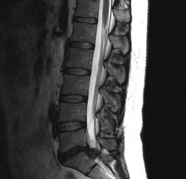 Diagnostične možnosti za ledveno osteohondrozo