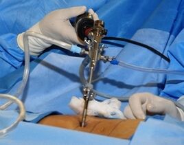 Kirurško zdravljenje ledvene osteohondroze