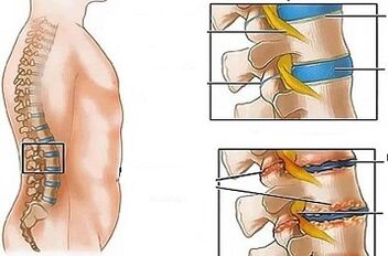 Razlogi za razvoj ledvene osteohondroze