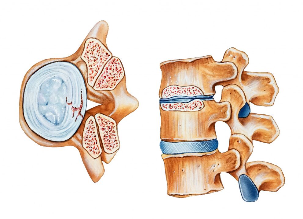 Osteohondroza regije materničnega vratu vodi v uničenje medvretenčnih diskov