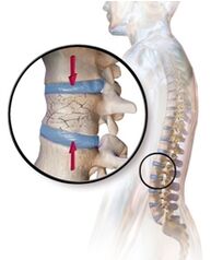 Osteoporoza izzove bolečine v hrbtu v spodnjem delu hrbta